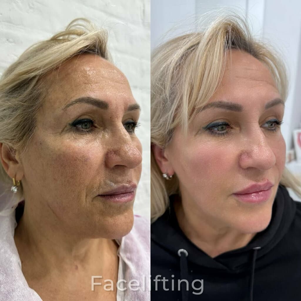 Салон красоты Фейслифтинг